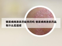 银屑病用激素药能停药吗 银屑病用激素药品有什么后遗症