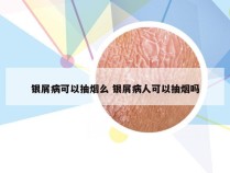 银屑病可以抽烟么 银屑病人可以抽烟吗