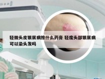 轻微头皮银屑病擦什么药膏 轻度头部银屑病可以染头发吗