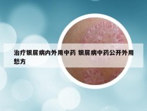 治疗银屑病内外用中药 银屑病中药公开外用愁方