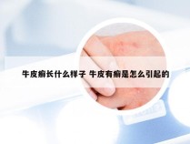 牛皮癣长什么样子 牛皮有癣是怎么引起的