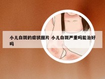 小儿白斑的症状图片 小儿白斑严重吗能治好吗