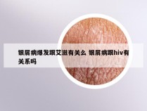 银屑病爆发跟艾滋有关么 银屑病跟hiv有关系吗