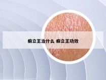 癣立王治什么 癣立王功效