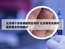 北京哪个皮肤病医院比较好 北京哪家皮肤科医院看皮肤病最好