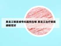 黑龙江银屑病专科医院在哪 黑龙江治疗银屑病哪家好