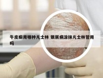 牛皮癣用哪种凡士林 银屑病涂抹凡士林管用吗