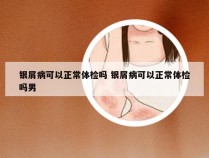 银屑病可以正常体检吗 银屑病可以正常体检吗男