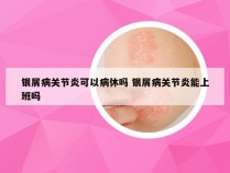 银屑病关节炎可以病休吗 银屑病关节炎能上班吗