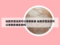 哈西奈德溶液可以用银屑病 哈西奈德溶液可以用银屑病皮肤吗