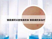 银屑病可以查免疫抗体 银屑病抗体治疗