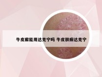 牛皮廨能用达克宁吗 牛皮肤癣达克宁