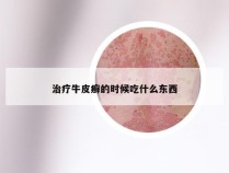 治疗牛皮癣的时候吃什么东西