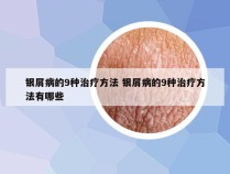 银屑病的9种治疗方法 银屑病的9种治疗方法有哪些