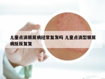 儿童点滴银屑病经常复发吗 儿童点滴型银屑病反反复复