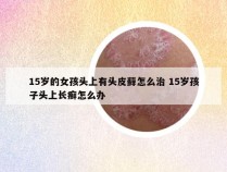 15岁的女孩头上有头皮藓怎么治 15岁孩子头上长癣怎么办