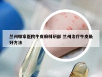 兰州哪家医院牛皮癣科研部 兰州治疗牛皮最好方法