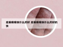 皮癣痒痒抹什么药好 皮癣痒痒抹什么药好的快