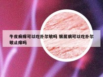 牛皮癣痒可以吃扑尔敏吗 银屑病可以吃扑尔敏止痒吗