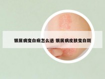 银屑病变白癍怎么退 银屑病皮肤变白斑