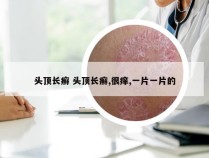 头顶长癣 头顶长癣,很痒,一片一片的