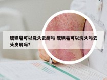 硫磺皂可以洗头去癣吗 硫磺皂可以洗头吗去头皮屑吗?