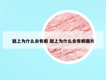 腿上为什么会有癣 腿上为什么会有癣图片