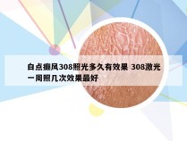 白点癫风308照光多久有效果 308激光一周照几次效果最好