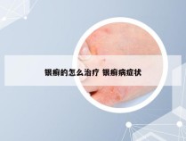 银癣的怎么治疗 银癣病症状