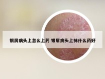 银屑病头上怎么上药 银屑病头上抹什么药好