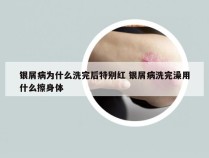 银屑病为什么洗完后特别红 银屑病洗完澡用什么擦身体