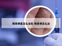 银屑病是怎么治愈 银屑病怎么冶