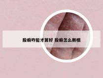 股癣咋能才算好 股癣怎么断根