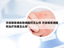 济南银屑病皮肤病医院怎么样 济南银屑病医院治疗效果怎么样