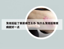 发烧后起了银屑病怎么办 为什么发烧后银屑病就好一点