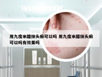 用九度米醋抹头癣可以吗 用九度米醋抹头癣可以吗有效果吗