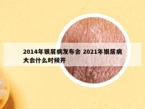 2014年银屑病发布会 2021年银屑病大会什么时候开