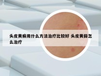 头皮黄癣用什么方法治疗比较好 头皮黄藓怎么治疗