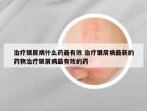 治疗银屑病什么药最有效 治疗银屑病最新的药物治疗银屑病最有效的药