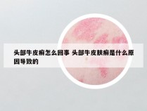 头部牛皮癣怎么回事 头部牛皮肤癣是什么原因导致的