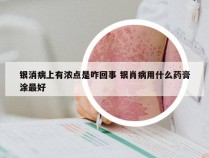 银消病上有浓点是咋回事 银肖病用什么药膏涂最好