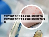 父亲生过孩子后才得银屑病会遗传给孩子吗 父亲生过孩子后才得银屑病会遗传给孩子吗视频