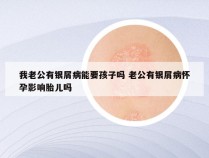 我老公有银屑病能要孩子吗 老公有银屑病怀孕影响胎儿吗