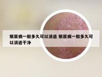 银屑病一般多久可以消退 银屑病一般多久可以消退干净