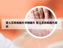 婴儿花斑癣图片早期图片 婴儿花斑癣图片症状