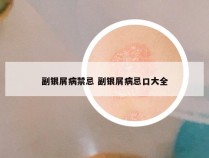 副银屑病禁忌 副银屑病忌口大全