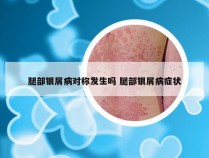 腿部银屑病对称发生吗 腿部银屑病症状