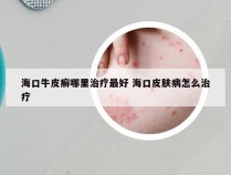 海口牛皮癣哪里治疗最好 海口皮肤病怎么治疗