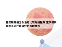 重庆银屑病怎么治疗比较好的医院 重庆银屑病怎么治疗比较好的医院推荐