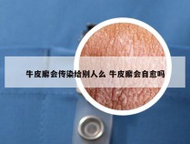 牛皮廨会传染给别人么 牛皮廨会自愈吗